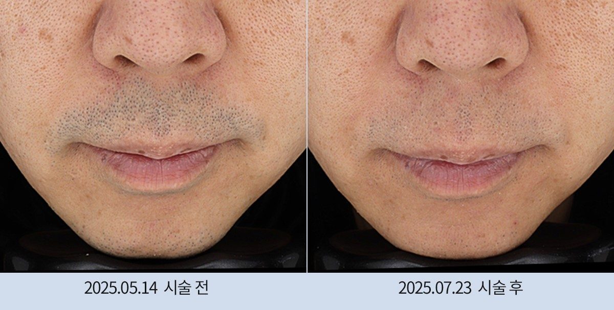 스노우의원 다산점 레이저 제모 전후